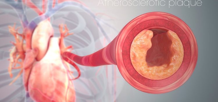 Heart Disease Causes: Know the #1 Culprit Heart Disease Causes: Know the #1 Culprit